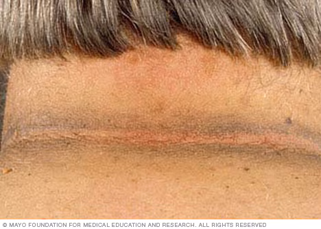 acanthosis-nigricans